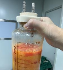 桂平水动力吸脂手术要做多久？